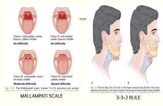 Rapid sequence intubation in ED | PPTX
