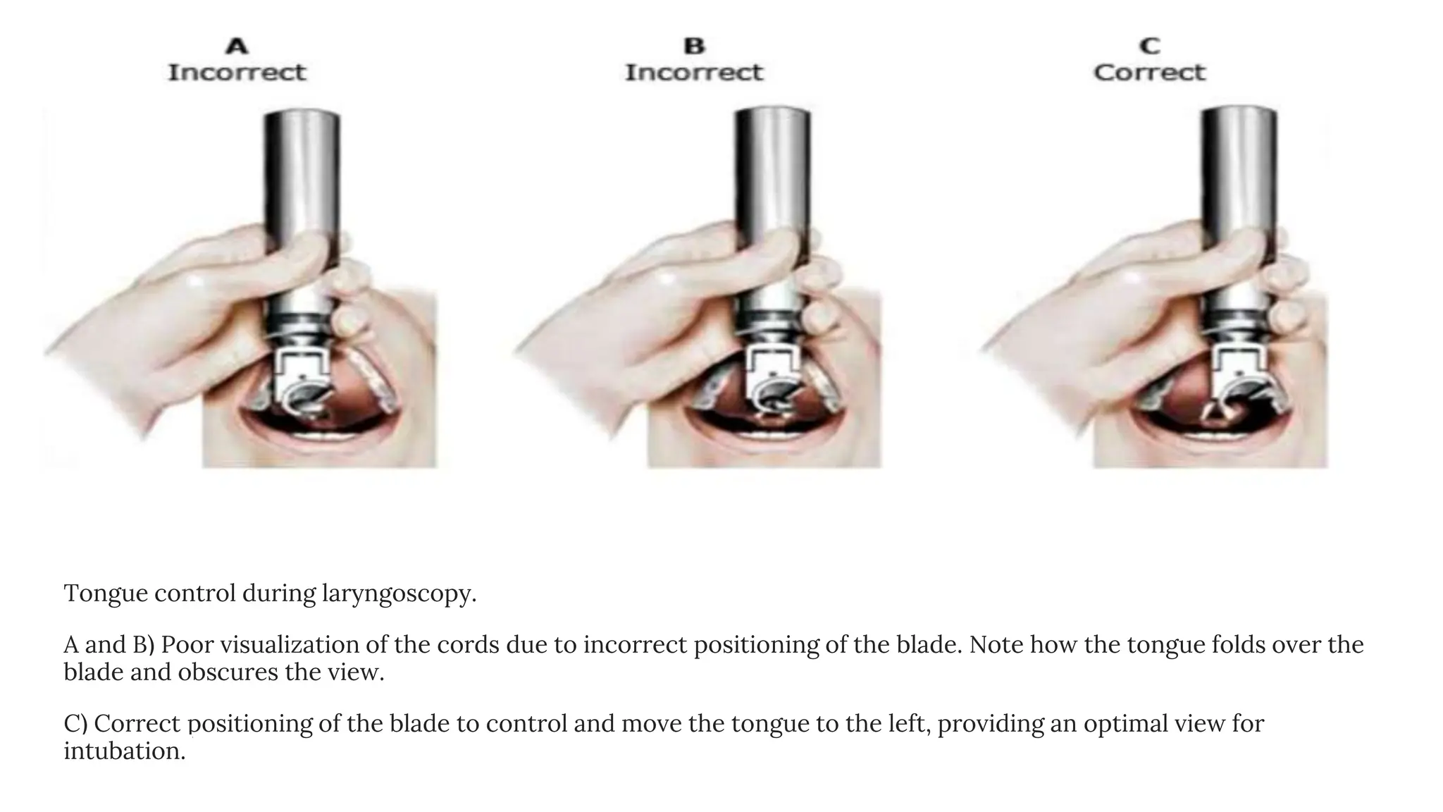 Tongue control during laryngoscopy.
A and B) Poor visualization of the cords due to incorrect positioning of the blade. Note how the tongue folds over the
blade and obscures the view.
C) Correct positioning of the blade to control and move the tongue to the left, providing an optimal view for
intubation.
 
