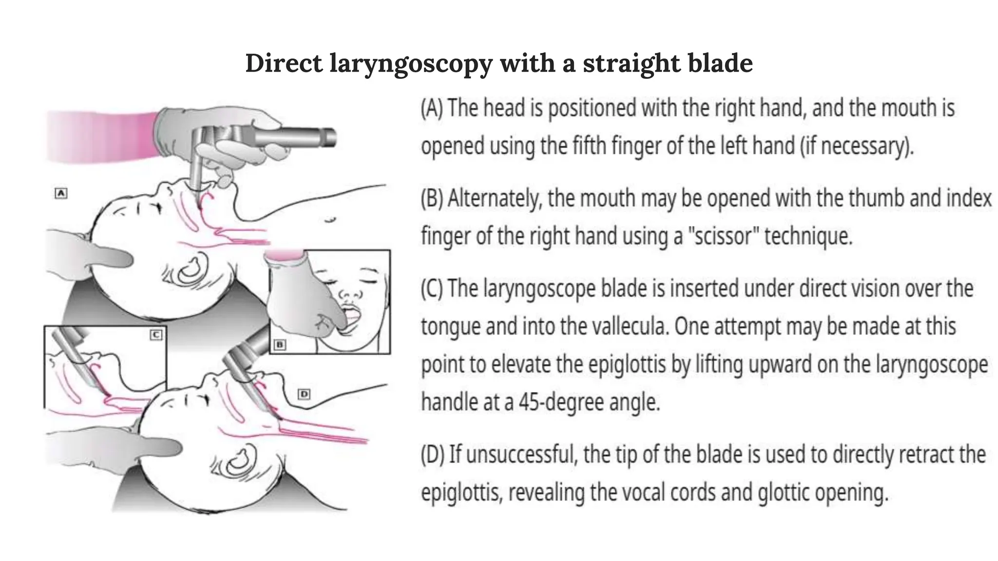 Direct laryngoscopy with a straight blade
 