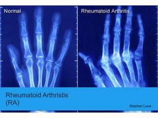 Rheumatoid Arthristis
(RA)                    Stephen Luce
 