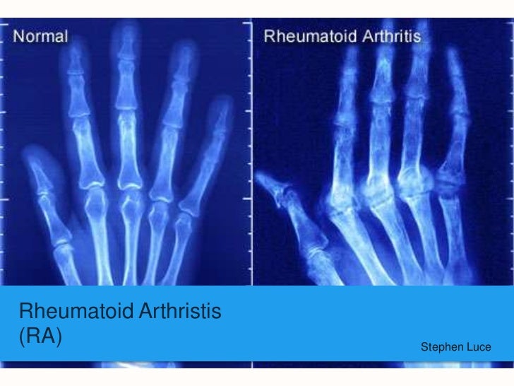 rheumatoid-arthritis-power-point