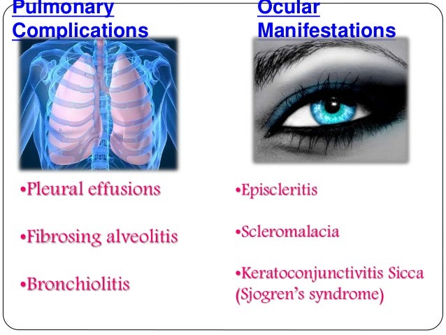 RHEUMATOID ARTHRITIS