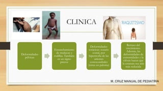 CLINICA
Deformidades
pélvicas
Ensanchamiento
de muñecas y
rodillas. También
es un signo
precoz
Deformidades
torácicas: rosario
costal, por
hipertrofia de las
uniones
costocondrales
(tórax en paloma)
Retraso del
crecimiento.
Además, las
deformidades de
extremidades y la
cifosis hacen que
la estatura sea aún
más reducida
M. CRUZ MANUAL DE PEDIATRIA
 