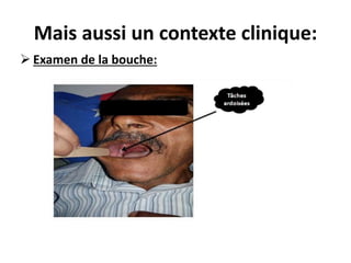 Mais aussi un contexte clinique:
 Examen de la bouche:
 