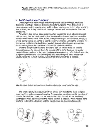 Fissuras de Tessier | PDF