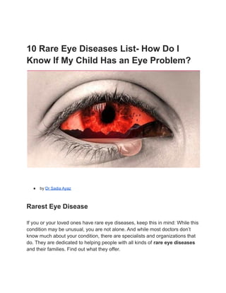 10 Rare Eye Diseases List- How Do I
Know If My Child Has an Eye Problem?
● by Dr Sadia Ayaz
Rarest Eye Disease
If you or your loved ones have rare eye diseases, keep this in mind: While this
condition may be unusual, you are not alone. And while most doctors don’t
know much about your condition, there are specialists and organizations that
do. They are dedicated to helping people with all kinds of rare eye diseases
and their families. Find out what they offer.
 