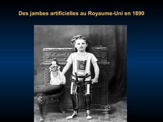 Des jambes artificielles au Royaume-Uni en 1890

 