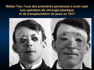 Walter Yeo, l’une des premières personnes à avoir subi
une opération de chirurgie plastique
et de transplantation de peau en 1917

 