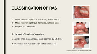 Minor Ras Ulcers Recurre t apthous ulcer presentation by dr maha jabin | PPTX