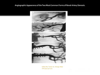 Angiographic Appearance of theTwo Most Common Forms of Renal-Artery Stenosis.
 