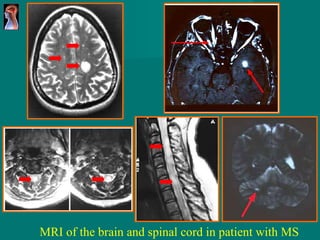 MRI of the brain and spinal cord in patient with MS 