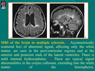 MRI of the brain in multiple sclerosis.   a   Asymmetrically   scattered foci of abnormal signal, affecting only the white matter,   are seen in the periventricular regions and at the anterior and posterior   ends of the lateral ventricles. There is mild internal hydrocephalus.   b   There are typical signal abnormalities in the corpus callosum,   extending into the white   matter of the hemispheres. 