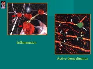 Active demyelination Inflammation 