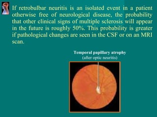 If retrobulbar neuritis is an isolated event in a patient otherwise free of neurological disease, the probability that other clinical signs of multiple sclerosis will appear in the future is roughly 50%. This probability is greater if pathological changes are seen in the CSF or on an MRI scan.  Temporal papillary atrophy (after optic neuritis) 
