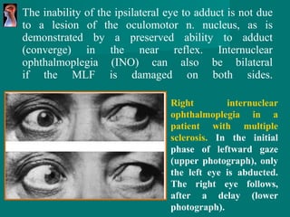 The inability   of the ipsilateral eye to adduct is not due to a lesion   of the oculomotor n. nucleus, as is demonstrated by   a preserved ability to adduct   (converge) in the near reflex.   Internuclear ophthalmoplegia (INO) can also be bilateral if the MLF is damaged on both sides. Right internuclear   ophthalmoplegia in a   patient with   multiple   sclerosis.  In the initial   phase of leftward gaze (upper photograph),   only   the left eye is abducted.   The right eye follows,   after a   delay (lower   photograph). 
