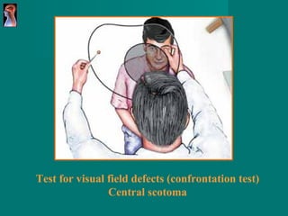 Test for visual field defects (confrontation test) Central scotoma 