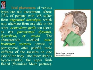 Ictal phenomena  of various types are not uncommon. About 1.5% of persons with MS suffer from  trigeminal   neuralgia ,  which may alternate from one side to the other.  Acute dizzy spells   can occur, as can  paroxysmal dystonia ,  dysarthria , or  ataxia.   The characteristic so - called  tonic brainstem seizures   consist of paroxysmal, often painful, tonic stiffness of the muscles on one side of the body. The lower limb is hyperextended, the upper limb flexed (Wernicke−Mann posture). 