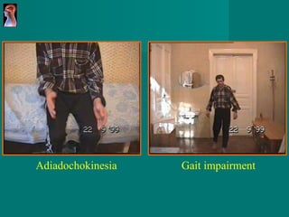 Adiadochokinesia Gait impairment 
