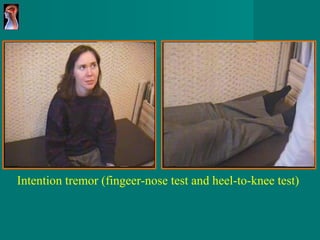 Intention tremor (fingeer-nose test and heel-to-knee test) 