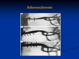 Atherosclerosis
 