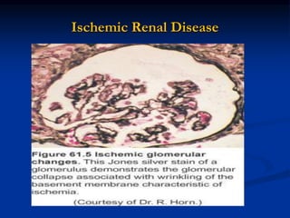 Ischemic Renal Disease
 