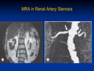 MRA in Renal Artery Stenosis
 