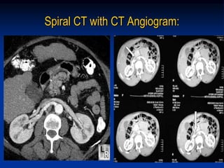 Spiral CT with CT Angiogram:
 