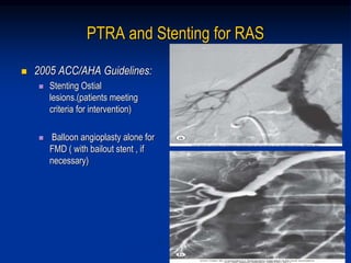 PTRA and Stenting for RAS
 2005 ACC/AHA Guidelines:
 Stenting Ostial
lesions.(patients meeting
criteria for intervention)
 Balloon angioplasty alone for
FMD ( with bailout stent , if
necessary)
 