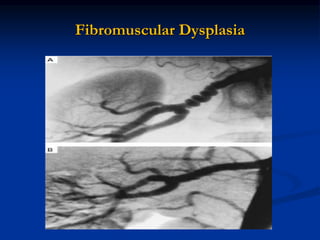 Fibromuscular Dysplasia
 