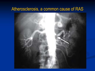 Atherosclerosis, a common cause of RAS
 