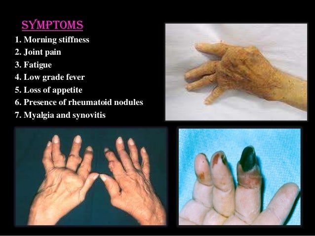 Rheumatoid Arthitis
