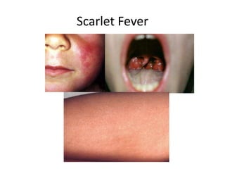 Approach To Common Pediatric Rashes pptx approach-to-common-pediatric-rashes-pptx
