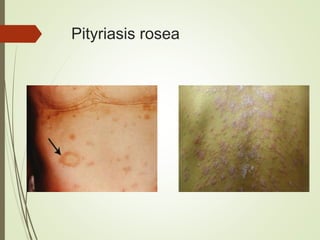 Pitea Rash Rashes in infants and children | PPTX