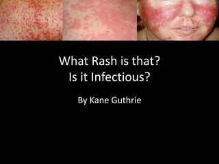 What Rash is that?
Is it Infectious?
By Kane Guthrie
 