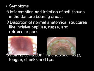 pre prosthetic mouth preparation | PPT