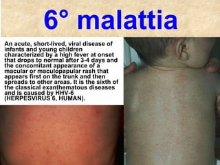Rash infettivi | PPT