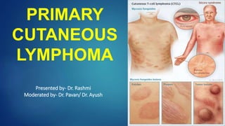 PRIMARY
CUTANEOUS
LYMPHOMA
Presented by- Dr. Rashmi
Moderated by- Dr. Pavan/ Dr. Ayush
 