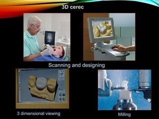 3D cerec

Scanning and designing

3 dimensional viewing

Milling

 