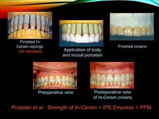 Finished InCeram copings
(Air abraded)

Application of body
and incisal porcelain

Preoperative veiw

Finished crowns

Postoperative veiw
of In-Ceram crowns

Probster et al : Strength of In-Ceram > IPS Empress < PFM

 