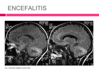 ENCEFALITIS
 