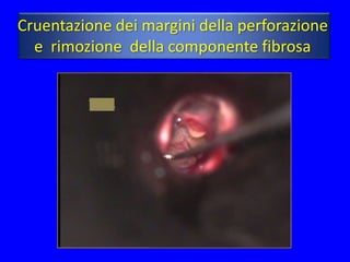 Cruentazione dei margini della perforazione
  e rimozione della componente fibrosa
 