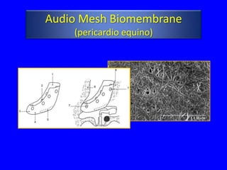 Audio Mesh Biomembrane
    (pericardio equino)
 