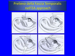 Prelievo della Fascia Temporalis
        nell’EA approach
 
