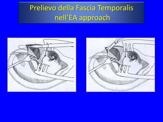 Prelievo della Fascia Temporalis
        nell’EA approach
 