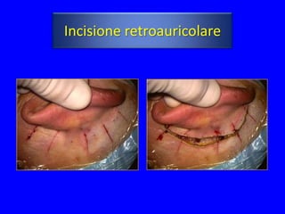 Incisione retroauricolare
 
