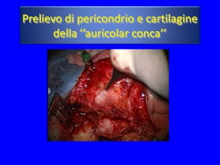 Prelievo di pericondrio e cartilagine
       della ’’auricolar conca’’
 