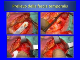 Prelievo della fascia temporalis
 