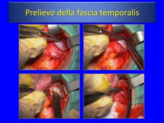 Prelievo della fascia temporalis
 