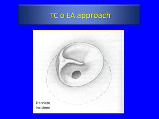 TC o EA approach




Tracciato
incisione
 