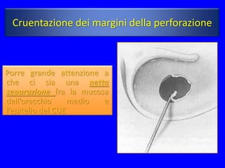 Cruentazione dei margini della perforazione



Porre grande attenzione a
che ci sia una netta
separazione fra la mucosa
dell’orecchio      medio e
l’epitelio del CUE
 